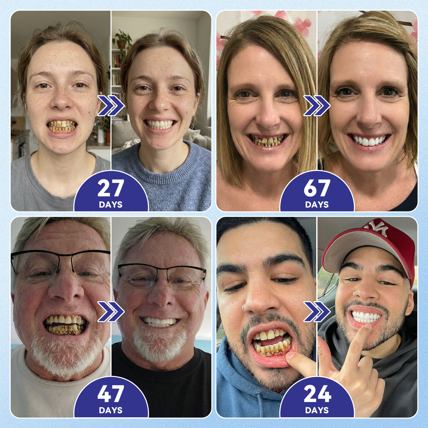 🦷𝐆𝐥𝐢𝐦𝐦𝐞𝐫𝐥𝐲® 🎟️𝐓𝐢𝐝𝐞𝐠𝐥𝐮𝐬𝐢𝐛 𝐓𝐨𝐨𝐭𝐡 & 𝐆𝐮𝐦 𝐑𝐞𝐩𝐚𝐢𝐫 𝐌𝐢𝐜𝐫𝐨𝐧𝐞𝐞𝐝𝐥𝐞 𝐏𝐚𝐭𝐜𝐡  | 𝐀𝐝𝐯𝐚𝐧𝐜𝐞𝐝 𝐒𝐭𝐞𝐦-𝐂𝐞𝐥𝐥 𝐀𝐜𝐭𝐢𝐯𝐚𝐭𝐢𝐨𝐧 𝐓𝐞𝐞𝐭𝐡 𝐒𝐭𝐫𝐢𝐩𝐬(🦷𝐑𝐞𝐛𝐮𝐢𝐥𝐝 𝐄𝐧𝐚𝐦𝐞𝐥 & 𝐃𝐞𝐧𝐭𝐢𝐧 • 𝐒𝐭𝐫𝐞𝐧𝐠𝐭𝐡𝐞𝐧 𝐆𝐮𝐦𝐬 • 𝐄𝐫𝐚𝐝𝐢𝐜𝐚𝐭𝐞 𝐓𝐚𝐫𝐭𝐚𝐫 & 𝐎𝐝𝐨𝐫 • 𝐒𝐭𝐨𝐩 𝐓𝐨𝐨𝐭𝐡 𝐒𝐞𝐧𝐬𝐢𝐭𝐢𝐯𝐢𝐭𝐲)