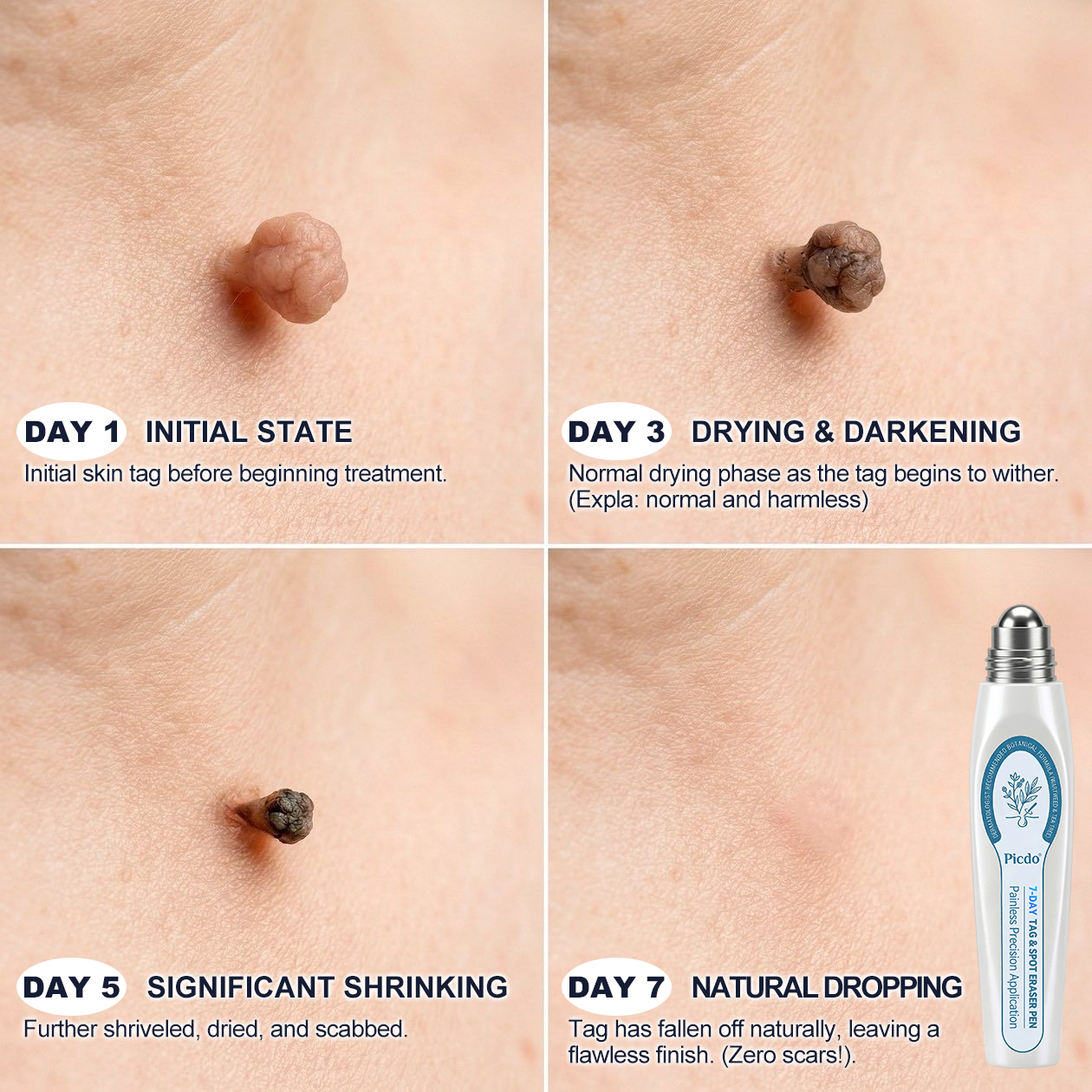 𝐏i𝐜𝐝o® 7-𝐷𝑎𝑦 𝗧𝐚𝐠 & 𝗦𝗽𝐨𝐭 𝐄𝐫𝒂𝒔𝒆𝒓(Zero Pain, Zero 𝐒𝐜𝐚𝒓𝒔 Rollerball)👩‍⚕️🌿