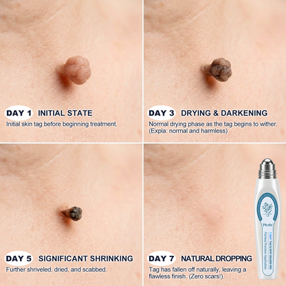 𝐏i𝐜𝐝o® 7-𝐷𝑎𝑦 𝗧𝐚𝐠 & 𝗦𝗽𝐨𝐭 𝐄𝐫𝒂𝒔𝒆𝒓(Zero Pain, Zero 𝐒𝐜𝐚𝒓𝒔 Rollerball)👩‍⚕️🌿